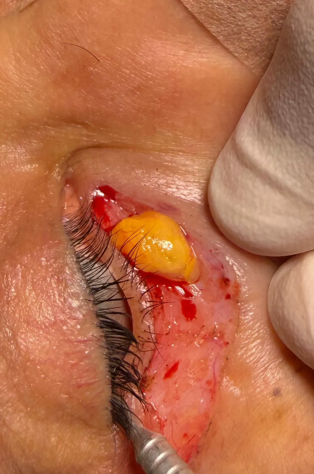 Pálpebra marcada para blefaroplastia