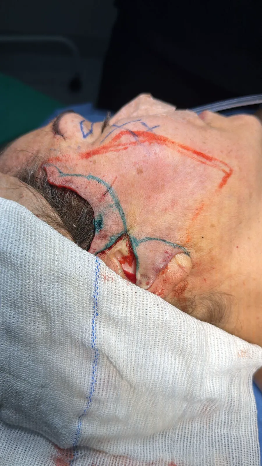 Marcação cirúrgica facial completa