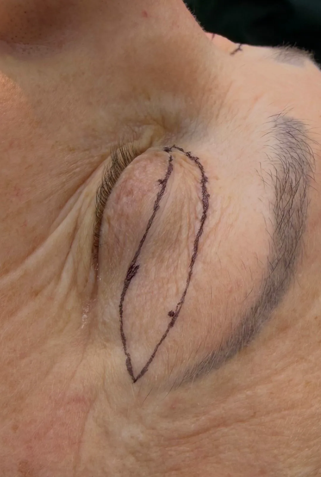Marcação de procedimento facial