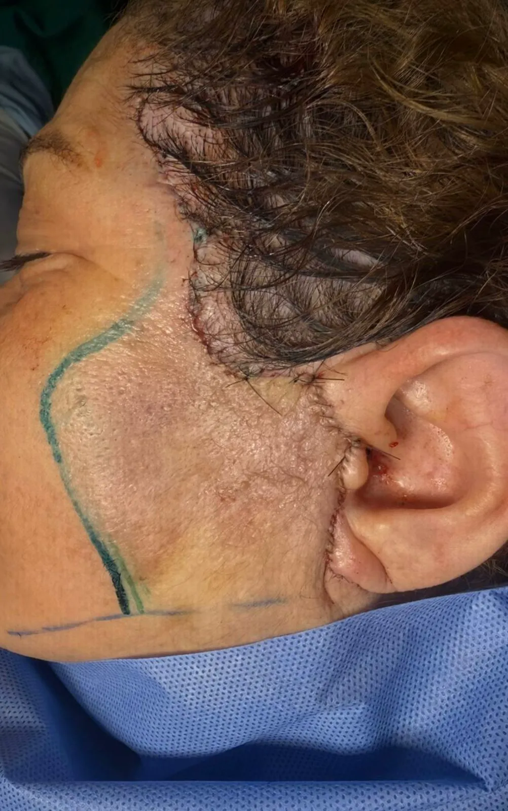 Sutura de lifting facial no centro cirúrgico do IDC