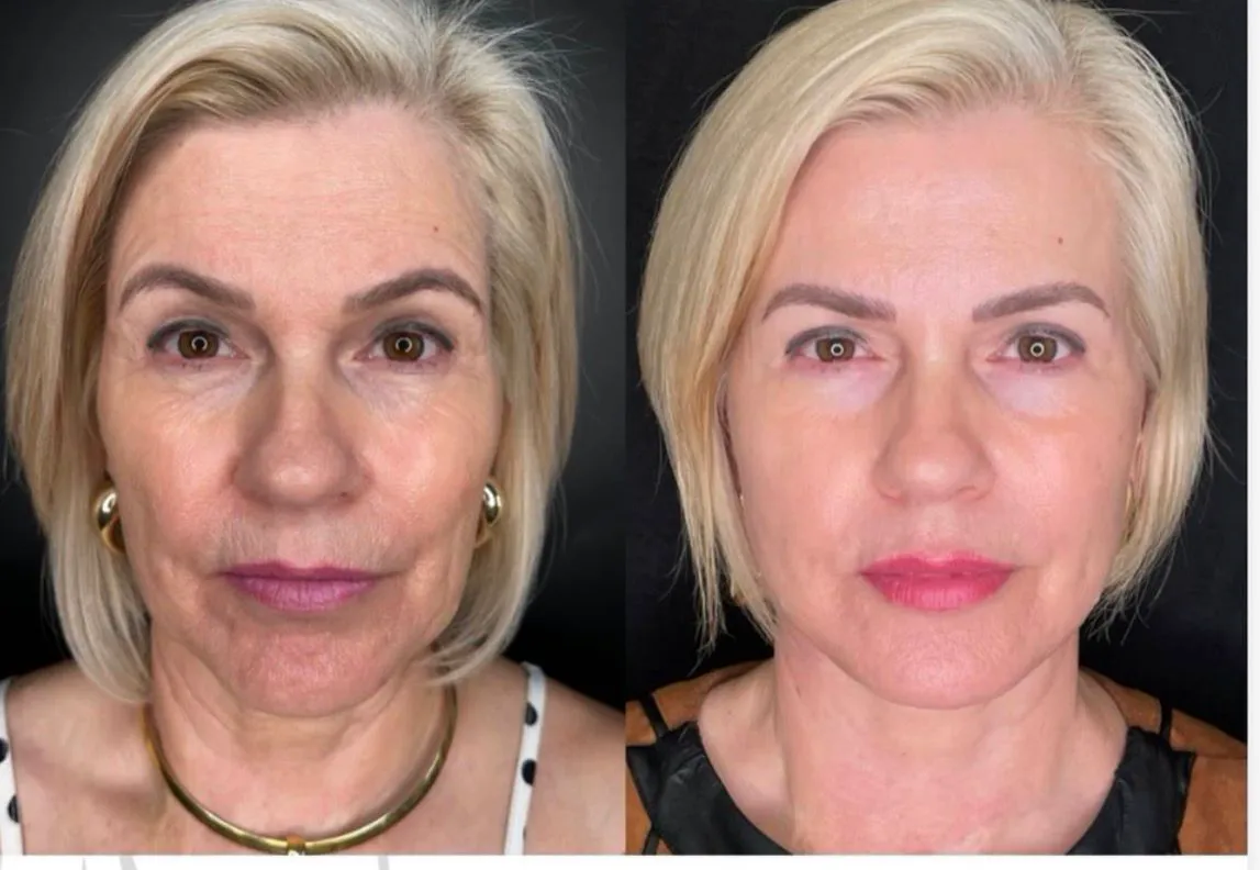 Resultado cirúrgico facial — antes e depois