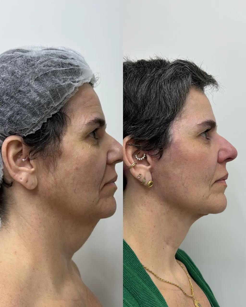 Detalhe de lifting facial no centro cirúrgico