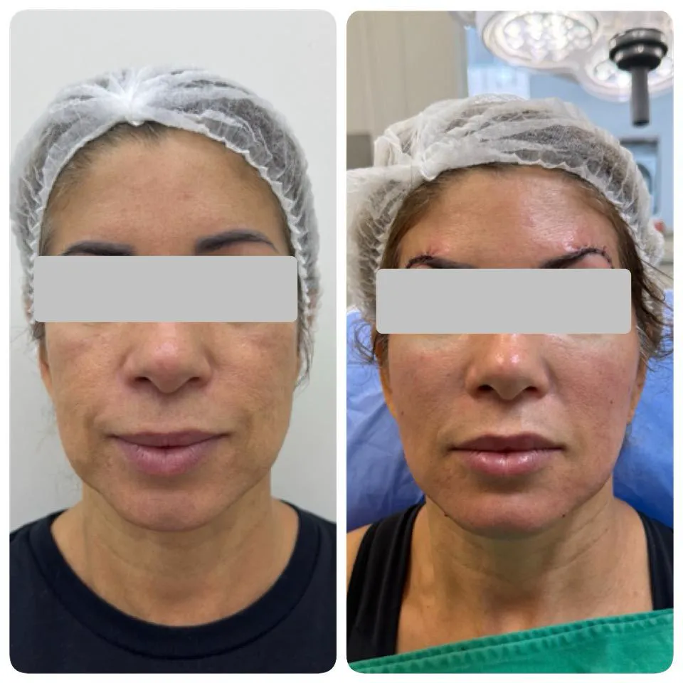 Resultado de lipoenxertia facial